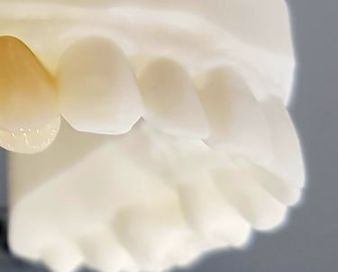 Moldura de dentes ilustrando implantes dentários realizados por dentista na Lapa PR.