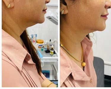Visible reduction of fine lines after PRP facial at Kandyan Aesthetics