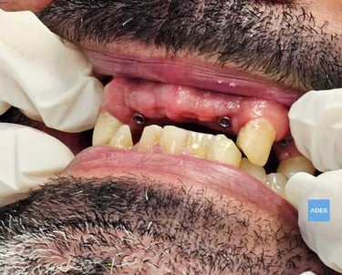 colocación implantes