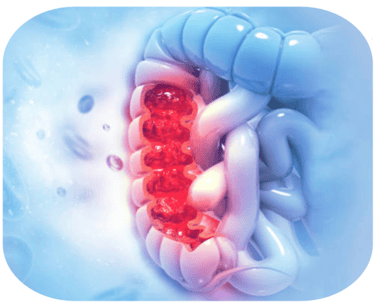illustration des MICI-Prise en charge nutritionnelle