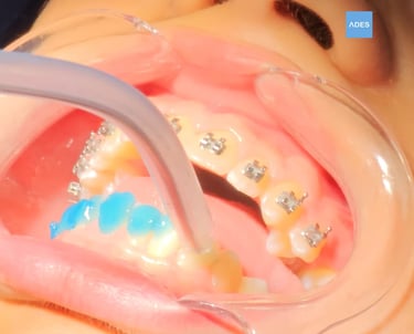 cementado brackets clinica dental ades