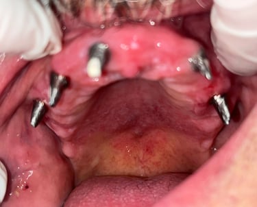 a close up of a person's mouth with a toothbrush