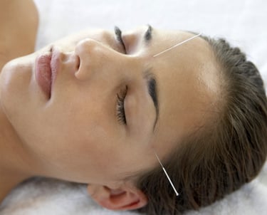 Close‑up of a person receiving acupuncture with fine needles placed on the forehead and temple