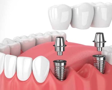 best dental implant specialist in baner