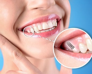 permanent tooth replacement in baner