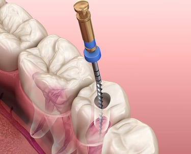 root canal treatment specialist