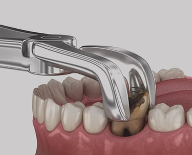tooth replacement surgery baner