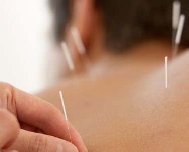 Acupuncture 