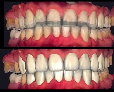 Diseño de sonrisa digital en distalclinic