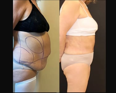 tummuy tuck before after photo, Antalya