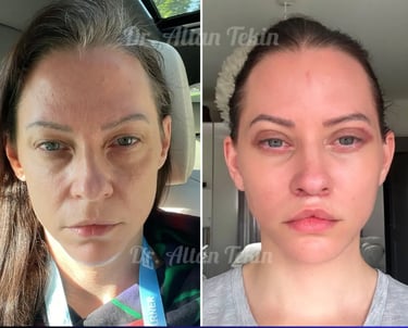 Augenlidoperation vorher und nachher