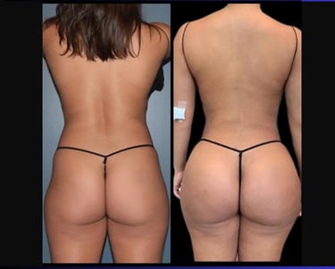 BBL before after photos in Antalya, Türkiye