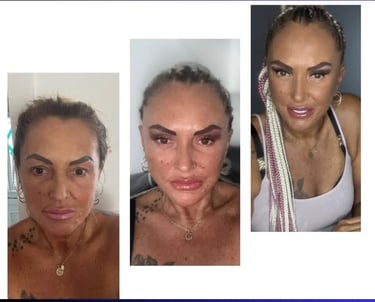 facelift, neck lift before after photo, Antalya