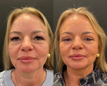 Augenlidoperation vorher und nachher