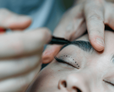 Göz kapağı estetiği uygulaması yapılmış göz