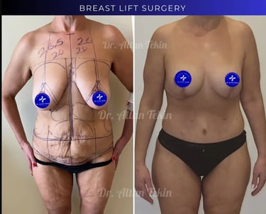 tummy tuck surgery before after photos in Antalya, Türkiye