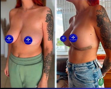 breast lift before after photos in Antalya, Turkey