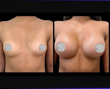 breast augmentation before after photos in Antalya, Türkiye