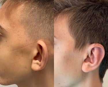 otoplasty before after photos in Antalya, Turkey