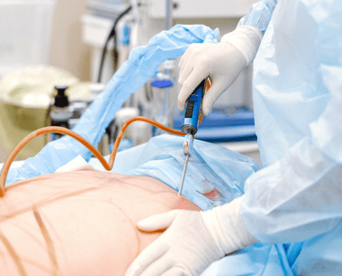 Liposakşın ile bölgesel yağ azaltma işlemi