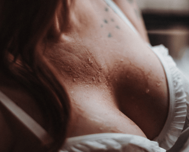 Mastopeksi uygulanmış meme