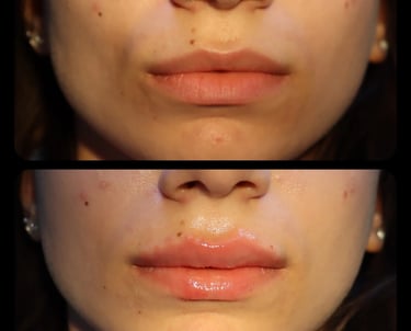 lip filler before after photo
