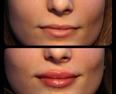 lip filler before after photo Antalya