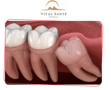 dentes siso, cirurgia de siso, dentista recreio