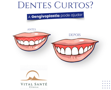 gengivoplastia recreio, dentista no recreio, dentistas no recreio