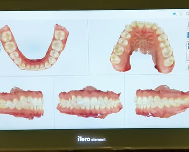 Scanner iTero usado em avaliação ortodôntica para Invisalign por dentista na Lapa PR.