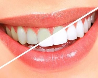 Resultado de antes e depois do clareamento dental na Vidaclin, clínica na Lapa PR.