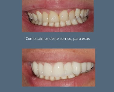 Mudança no sorriso, com planejamento de facetas em Curitiba no Bairro Batel.