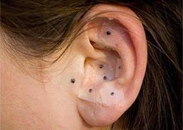 sevrage tabagique par auriculothérapie à Nîmes