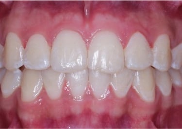 Sonrisa despues de tratamiento de ortodoncia