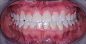 Sonrisa despues de terminar tratamiento de ortodoncia