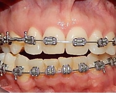 Sonrisa con brackets en tratamiento incompleto