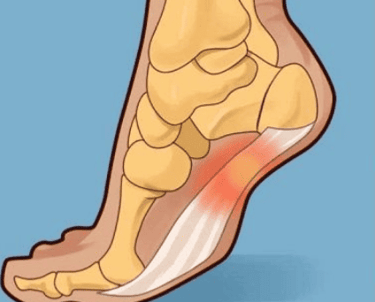 Tratamiento de Facitis Plantar