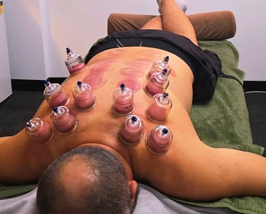 male with lots of cupping being done on his back in Wollongong