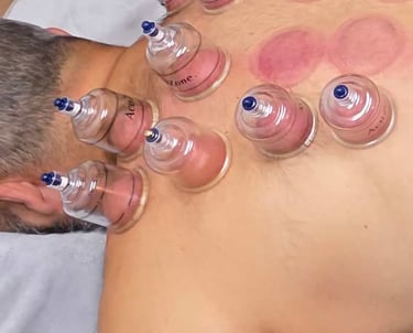 view from above of cupping being done on a male laying on a bed.