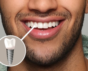 Dental implants East Bay Dental in Largo