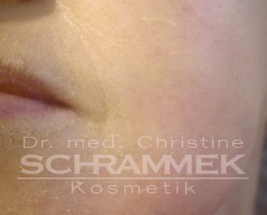 a woman after green peel energy from dr schrammek