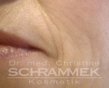 a woman before green peel energy from dr schrammek