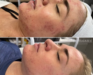 a woman comparation after and before green peel express 