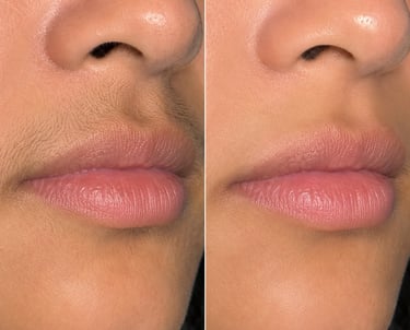 before and after laser hair removal