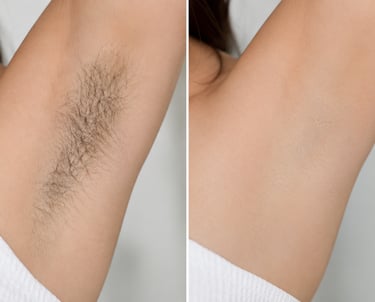 before and after laser hair removal