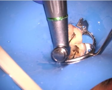 A high-speed dental drill performing a root canal procedure on a tooth isolated by a blue rubber dam.