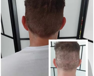 homme qui a une cicatrice sur le cuir chevelu