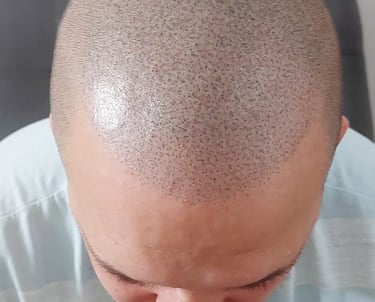 micropigmentation capillaire, effet crâne rasé
