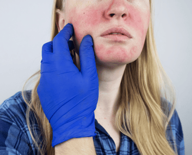Rosacea Treatment