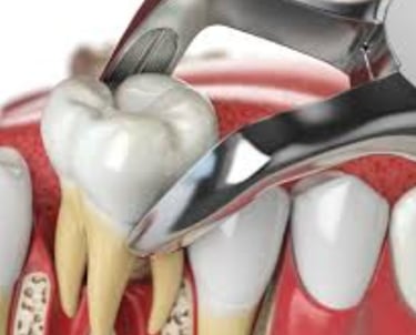 A dental model showing professional tooth extraction using forceps on a molar with roots.